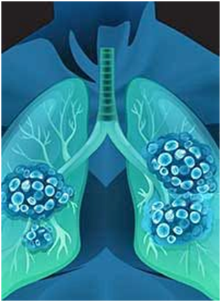 Perioperative Durvalumab Plus Chemo Yields Responses, EFS Benefit in Resectable  NSCLC 