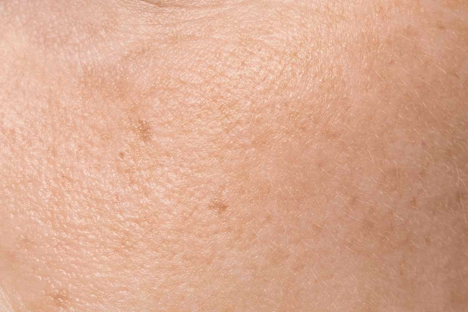 Deep Learning in Dermatology: Advancing Skin Disease Diagnosis with AI-Driven Precision